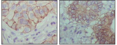 Figure 2: Immunohistochemical analysis of paraffin-embedded human lung cancer (left) and colon cancer (right) showing cytoplasmic localization with DAB staining using EphB1 mouse mAb.