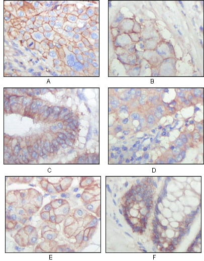 Figure 2: Immunohistochemical analysis of paraffin-embedded human lung squamous cell carcinoma (A), lung adenocarcinoma (B), colon carcinoma (C), breast carcinoma (D), normal sublingual gland (E), normal rectal (F), showing membrane localization with DAB staining using EphB3 mouse mAb.