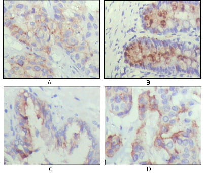 Figure 2: Immunohistochemical analysis of paraffin-embedded human lung cancer (A), recturn(B), prostate (C), colon cancer (D) showing cytoplasmic localization using IGFBP2 mouse mAb with DAB staining.
