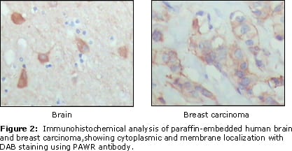 Figure 2: Immunohistochemical analysis of paraffin-embedded human brain (left) and breast carcinoma (right), showing cytoplasmic and membrane localization using PAR4 mouse mAb with DAB staining.