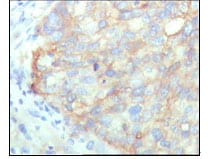Figure 2: Immunohistochemical analysis of paraffin-embedded human cervical carcinoma, showing cytoplasmic localization with DAB staining using KARS mouse mAb.