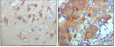 Figure 2: Immunohistochemical analysis of paraffin-embedded human cerebra (left) and breast carcinoma tissue (right),showing cytoplasmic and membrane location with DAB staining using ERBB3 mouse mAb.