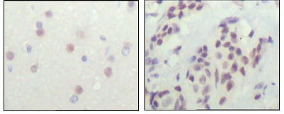 Figure 2: Immunohistochemical analysis of paraffin-embedded human cerebra (left) and breast carcinoma tissue (right), showing nuclear location with DAB staining using NCOR1 mouse mAb.