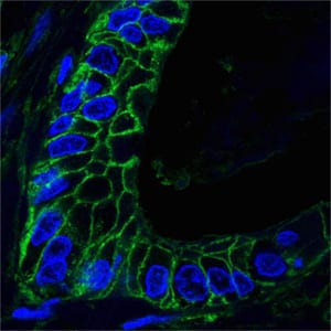 Figure 4: Confocal analysis of paraffin-embedded human lung cancer tissues using CD44 mouse mAb (green), showing membrane localization. Blue: DRAQ5 fluorescent DNA dye.