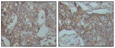 Figure 3: Immunohistochemical analysis of paraffin-embedded human breast carcinoma tissues, showing membrane localization with DAB staining using CD44 mouse mAb.