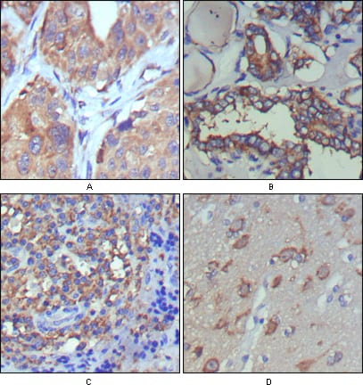 Figure 2: Immunohistochemical analysis of paraffin-embedded human lung cancer (A), thyroid cancer (B), lymph node (C) and brain (D) showing cytoplasmic and extracellular matrix localization using WNT5A mouse mAb with DAB staining.