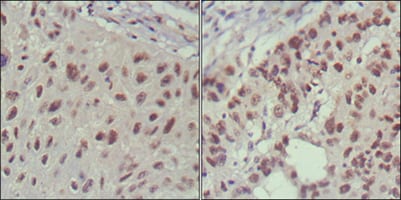 Figure 2: Immunohistochemical analysis of paraffin-embedded human lung cancer (left) and cervical carcinoma (right), showing nuclear localization using ISL1 mouse mAb with DAB staining.