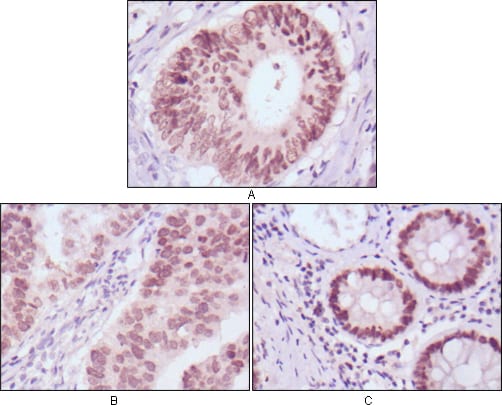 Figure 2: Immunohistochemical analysis of paraffin-embedded human colon cancer (A), gastric cancer (B) and rectal cancer (C) tissues using FOXA2 mouse mAb with DAB staining.