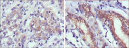 Figure 2: Immunohistochemical analysis of paraffin-embedded human gastric cancer (left) and normal gastric tissues (right) using CER1 mouse mAb with DAB staining.