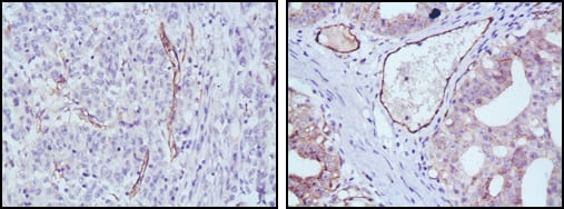 Figure 2: Immunohistochemical analysis of paraffin-embedded human stomach cancer (left) and ovary cancer (right) tissues using eNOS mouse mAb with DAB staining.