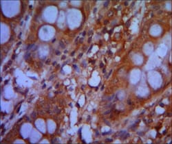 Figure 2: Immunohistochemical analysis of paraffin-embedded colon cancer tissues using CHD3 mouse mAb with DAB staining.