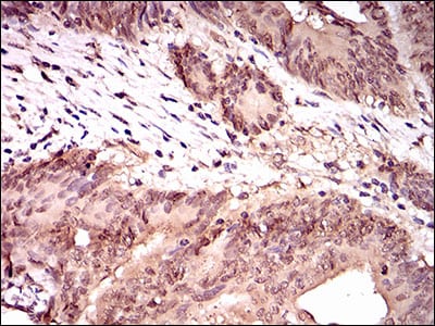 Figure 3: Immunohistochemical analysis of paraffin-embedded colon cancer tissues using PPP1CC mouse mAb with DAB staining.