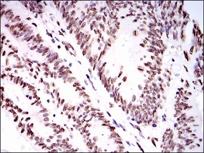 Figure 3: Immunohistochemical analysis of paraffin-embedded colon cancer tissues using HNRNPU mouse mAb with DAB staining.