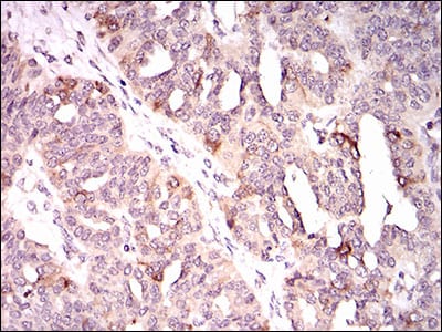 Figure 3: Immunohistochemical analysis of paraffin-embedded ovarian cancer tissues using KIF11 mouse mAb with DAB staining.