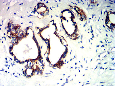 Figure 7:Immunohistochemical analysis of paraffin-embedded prostate cancer tissues using KRT10 mouse mAb with DAB staining.
