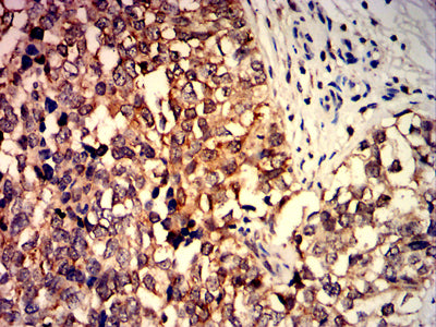 Figure 7:Immunohistochemical analysis of paraffin-embedded bladder cancer tissues using TNFSF9 mouse mAb with DAB staining.