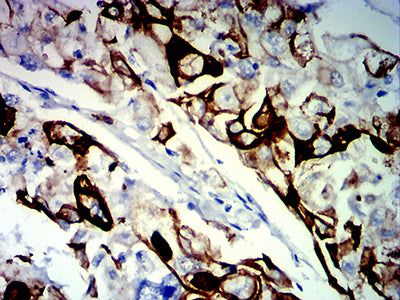 Figure 8:Immunohistochemical analysis of paraffin-embedded breast cancer tissues using KRT13 mouse mAb with DAB staining.