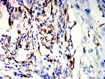 Figure 5:Immunohistochemical analysis of paraffin-embedded lung cancer tissues using CD226 mouse mAb with DAB staining.