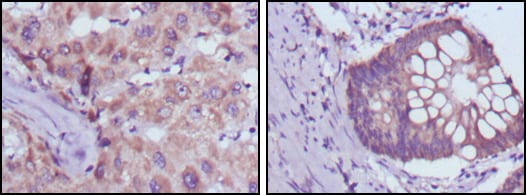 Figure 3: Immunohistochemical analysis of paraffin-embedded human liver cancer (left) and colorectal cancer tissues (right) using BDH1 mouse mAb with DAB staining.