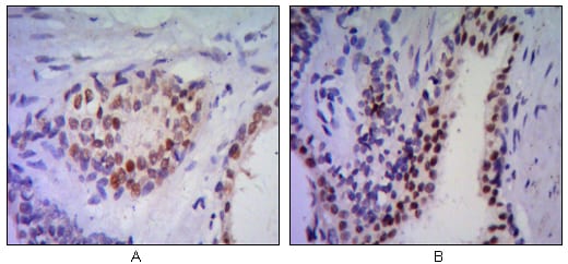 Figure 2: Immunohistochemical analysis of paraffin-embedded human prostata tissues (A, B) using anti-NKX3A antibody with DAB staining.