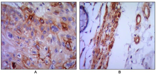 Figure 2: Immunohistochemical analysis of paraffin-embedded human lung cancer (A) and colon cancer (B) using VCAM1 mouse mAb with DAB staining.