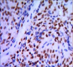 Figure 3: Immunohistochemical analysis of paraffin-embedded pancreatic cancer, using GATA1 mouse mAb with DAB staining.