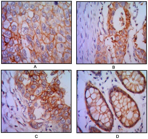 Figure 2: Immunohistochemical analysis of paraffin-embedded human lung cancer (A), colon cancer (B), breast cancer (C) and rectal cancer(D), using EPCAM mouse mAb with DAB staining.