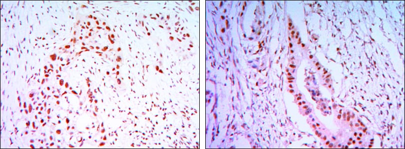 Figure 2: Immunohistochemical analysis of paraffin-embedded lung cancer tissues (left) and colon cancer tissues (right) using CDC27 mouse mAb with DAB staining.