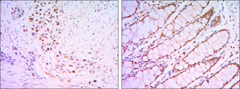 Figure 2: Immunohistochemical analysis of paraffin-embedded lung cancer tissues (left) and human rectum tissues (right) using KLF4 mouse mAb with DAB staining.