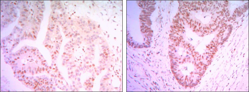 Figure 2: Immunohistochemical analysis of paraffin-embedded colon cancer tissues (left) and ovary cancer tissues (right) using THAP11 mouse mAb with DAB staining.