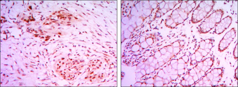 Figure 2: Immunohistochemical analysis of paraffin-embedded colon cancer tissues (left) and human larynx cancer tissues (right) using KDM4A mouse mAb with DAB staining.