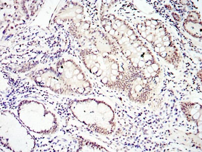 Figure 3: Immunohistochemical analysis of paraffin-embedded lung cancer tissues using SMAD4 mouse mAb with DAB staining.