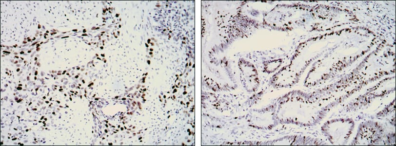 Figure 2: Immunohistochemical analysis of paraffin-embedded lung cancer (left) and rectal cancer (right) using KI67 mouse mAb with DAB staining.