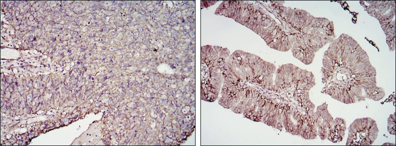 Figure 2: Immunohistochemical analysis of paraffin-embedded cervical cancer tissues (left) and ovarian cancer tissues (right) using CD276 mouse mAb with DAB staining.