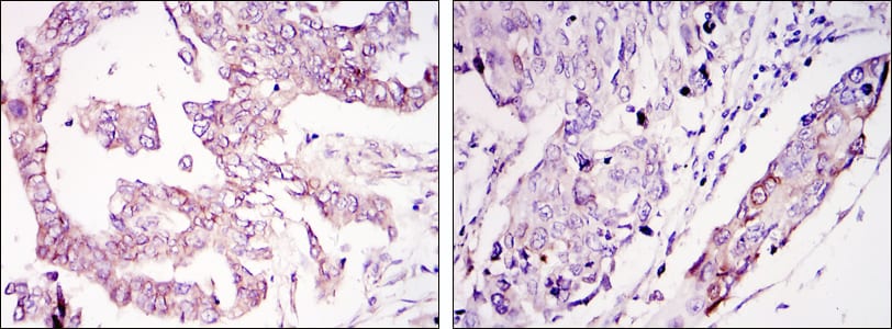 Figure 2: Immunohistochemical analysis of paraffin-embedded ovary tumour tissues (left) and lung cancer (right) using WIF1 mouse mAb with DAB staining.