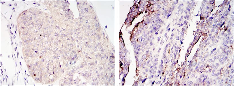 Figure 2: Immunohistochemical analysis of paraffin-embedded ovary tumour tissues (left) and lung cancer (right) using CRTC2 mouse mAb with DAB staining.