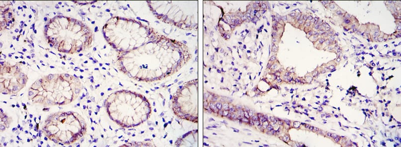 Figure 2: Immunohistochemical analysis of paraffin-embedded gastric cancer tissues (left) and lung cancer tissues (right) using CDH1 mouse mAb with DAB staining.