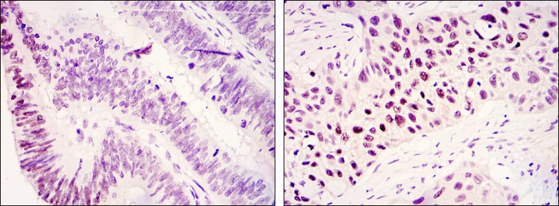 Figure 2: Immunohistochemical analysis of paraffin-embedded colonic cancer tissues (left) and lung cancer tissues (right) using KDM3A mouse mAb with DAB staining.