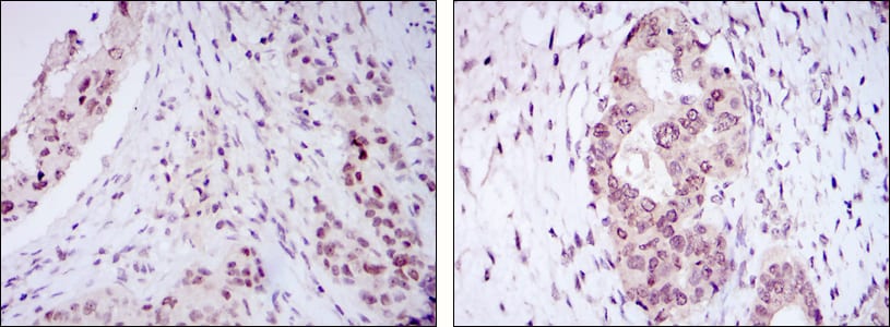 Figure 2: Immunohistochemical analysis of paraffin-embedded mammary cancer tissues (left) and ovarian cancer tissues (right) using NACC1 mouse mAb with DAB staining.