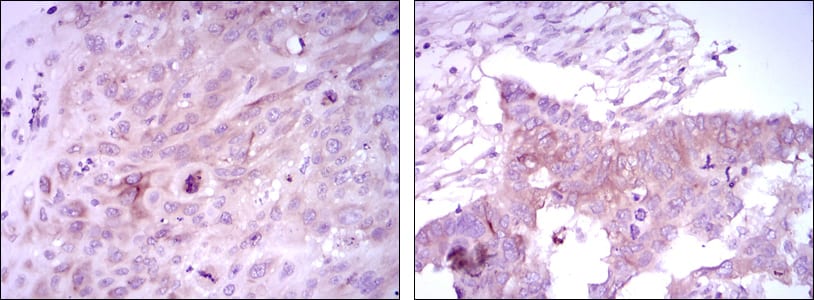 Figure 2: Immunohistochemical analysis of paraffin-embedded lung cancer tissues (left) and ovarian cancer tissues (right) using FOXD3 mouse mAb with DAB staining.