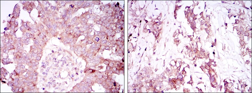 Figure 2: Immunohistochemical analysis of paraffin-embedded ovarian cancer tissues (left) and lung cancer tissues (right) using ATXN1 mouse mAb with DAB staining.