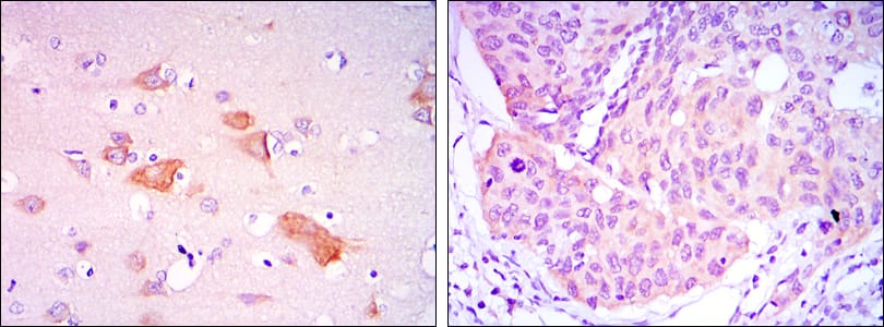 Figure 2: Immunohistochemical analysis of paraffin-embedded brain tissues (left) and lung cancer tissues (right) using SMAD5 mouse mAb with DAB staining.