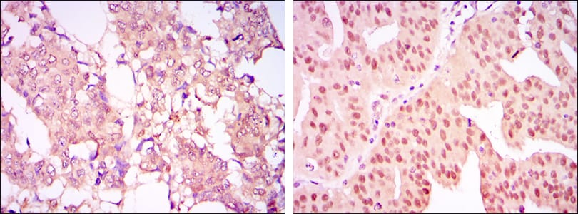 Figure 2: Immunohistochemical analysis of paraffin-embedded breast cancer tissues (left) and ovarian cancer tissues (right) using CARM1 mouse mAb with DAB staining.