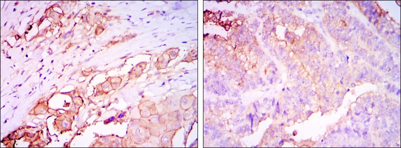 Figure 2: Immunohistochemical analysis of paraffin-embedded rectum cancer tissues (left) and stomach cancer tissues (right) using CEA mouse mAb with DAB staining.