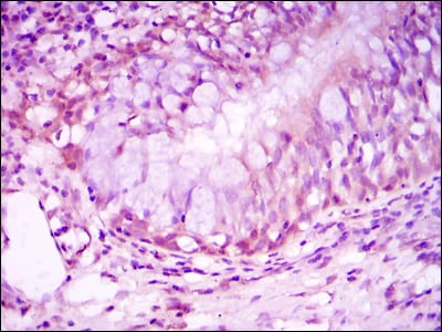 Figure 2: Immunohistochemical analysis of paraffin-embedded lung cancer tissues using NR3C1 mouse mAb with DAB staining.