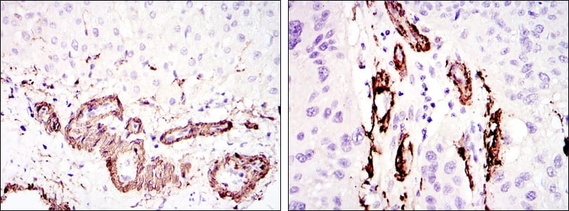 Figure 2: Immunohistochemical analysis of paraffin-embedded liver tissues (left) and lung cancer tissues (right) using ACTA2 mouse mAb with DAB staining.