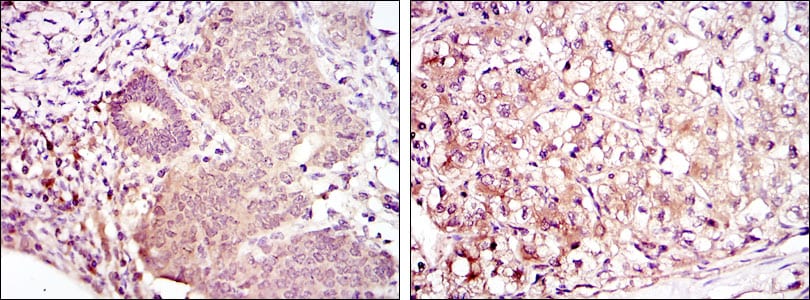 Figure 2: Immunohistochemical analysis of paraffin-embedded ovarian cancer (left) and kidney cancer (right) using MAP2K6 mouse mAb with DAB staining.