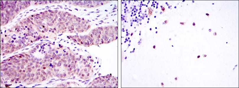 Figure 2: Immunohistochemical analysis of paraffin-embedded ovarian cancer (left) and cerebellum tissues (right) using MSI2 mouse mAb with DAB staining.