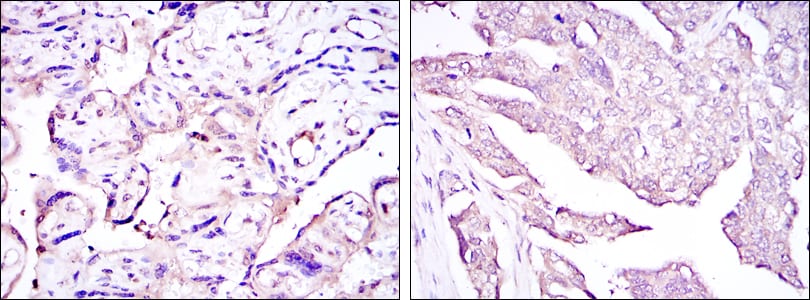 Figure 2: Immunohistochemical analysis of paraffin-embedded placenta tissues (left) and ovarian cancer (right) using E7 mouse mAb with DAB staining.