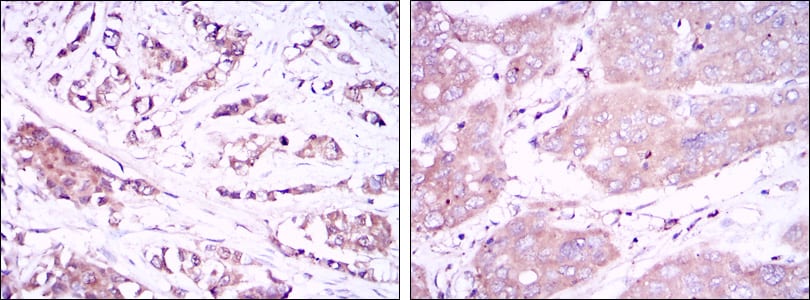 Figure 2: Immunohistochemical analysis of paraffin-embedded breast cancer tissues (left) and liver cancer tissues (right) using BECN1 mouse mAb with DAB staining.